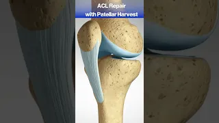 What Happens When You Tear Your ACL?