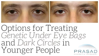 How Genetic Eye Bags and Dark Circles can be Treated in Younger People