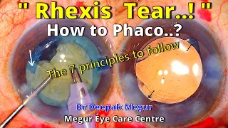 Phaco in an eye with torn Rhexis.The 7 principles to follow - Dr Deepak Megur