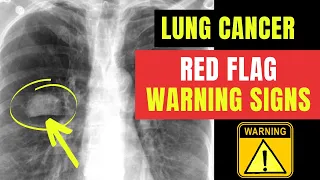 How to spot RED FLAG warning signs & symptoms of LUNG CANCER... Doctor O'Donovan explains