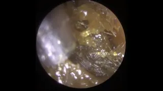 760 - Pulpy Glutinous Ear Wax Removal