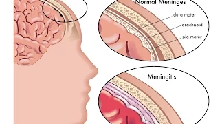 Meningitis