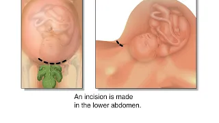 Cesarean section Health Video  Animation Medical Encyclop