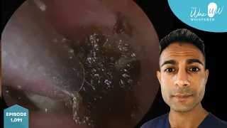 1,091 - Deep Dark Impacted Ear Wax Removal