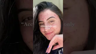 NO ACCUTANE ACNE TRANSFORMATION