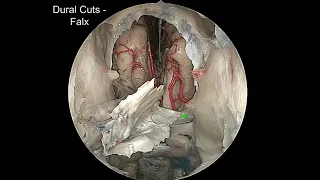 Neurosurgery On the Go: Transnasal and Surgical Anatomy of the Anterior Skull Base