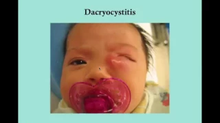 Dacryocystitis   CRASH! USMLE Step 2 and 3