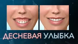 Десневая улыбка. Как исправить. Коррекция десневой улыбки.