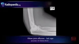 Elbow joint effusion and the sail sign - radiology video tutorial (x-ray)