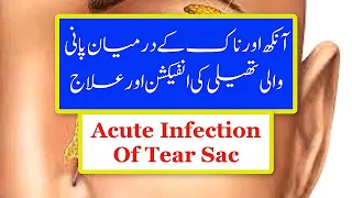 Acute Infection Of Tear Sac Treatment | Urdu/Hind