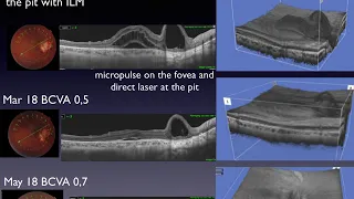 From pit to coloboma