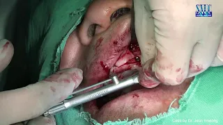 Upper full placement & Sinus Lateral by SNUCONE  KOR
