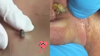 Ultimate Pimple Popping Extravaganza 2024! 💥👀