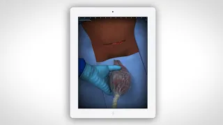 Touch Surgery Simulation - Cesarean section