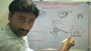 Anterior maxillary osteotomy - Cupar method