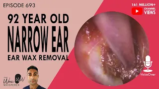 693 - 92 Year Old Narrow Ear Ear Wax Removal