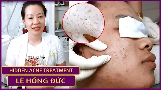 Hidden Acne Treatment | Điều trị mụn hiệu quả số 1 TPHCM | Hiền Vân Spa |Lê Hồng Đức| P2|551