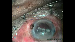 AIOC2021 - VT87 - SURGICAL TECHNIQUES FOR REMOVAL OF INTRACORNEAL FOREIGN BODIES.