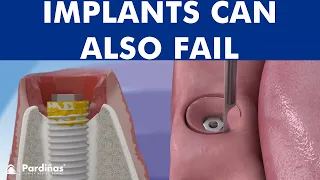 Peri-implantitis - Dental implant infection ©