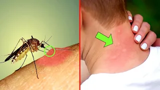 Why Do Mosquito Bites Itch | Mosquito Bites Itch | Mosquito Bite | #ALWAYSBRIGHTSIDE