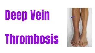 DVT || Deep vein Thrombosis