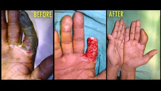 SALVAGE GANGRENE FINGER