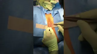 Labiaplasty