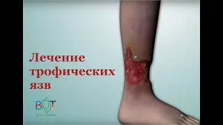 Эффективное лечение длительно незаживающих трофических язв