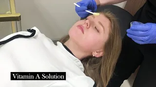 Best Peel for Pigment, Sun Damage + Melasma | Nashville Licensed Esthetician