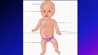 Achondroplasia