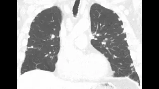 STR Cardiothoracic Case Webinar 4/16/2020