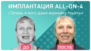 Имплантация all-on-4 как меняется питание после восстановления зубов