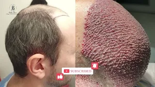 hair transplant in Bellus clinic