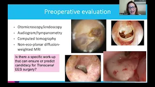 Transcanal Endoscopic Management of Cholesteotoma by Maura Cosetti, MD