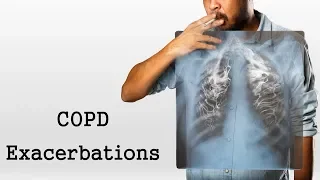 COPD Exacerbations