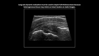 Full-thickness tear of the supraspinatus tendon on shoulder ultrasound (case 7)