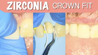 HOW TO CEMENT A ZIRCONIA CROWN | 4K Resolution