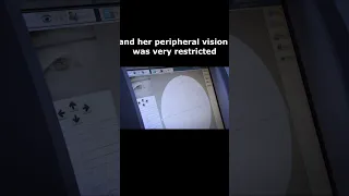 optic neuritis patient’s feedback after 3 months home vision therapy