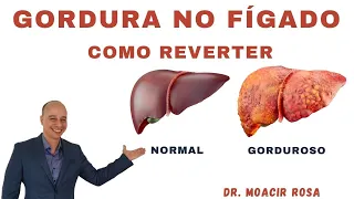 GORDURA NO FÍGADO: Como Reverter || Dr. Moacir Rosa