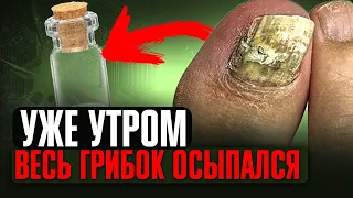 Даже за 8 мин. Грибок осыпается! Запомни 2 способа как избавиться от грибка ногтей (важно)