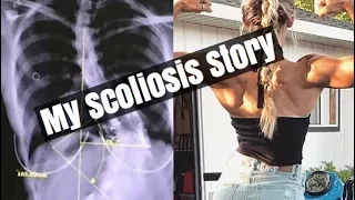 My Scoliosis Story