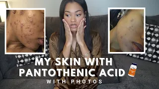 Pantothenic Acid for Acne - Before & After | Pantothenic Acid with Photos | Pantothenic Acid Update