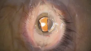 Deconstructing Cataract Surgery 1 - Removing the speculum