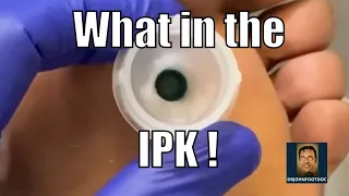 WHAT in the IPK ? (Intractable Plantar Keratosis)