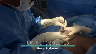 Breast Reduction - Dr. Nicholas Jones | Lexington Plastic Surgeons