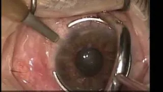 Anterior chamber worm, eye worms