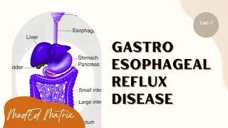 GERD | Reflux esophagitis | Risk factors | Pathogenesis | Morphology | Clinical features | Treatment