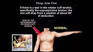 Rotator cuff tear ,Drop Arm Test - Everything You Need To Know - Dr. Nabil Ebraheim