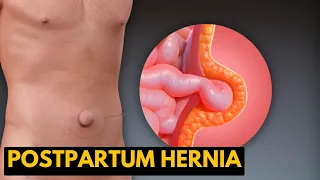 Postpartum Hernia, Causes, Signs and Symptoms, Diagnosis and Treatment.