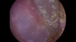 Soft Ear Wax and Skin Peel off Tympanic Membrane - #407